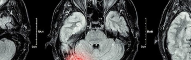 New Technology Enables Novel Use Of Brain Biomarker In Multiple Sclerosis thumbnail image